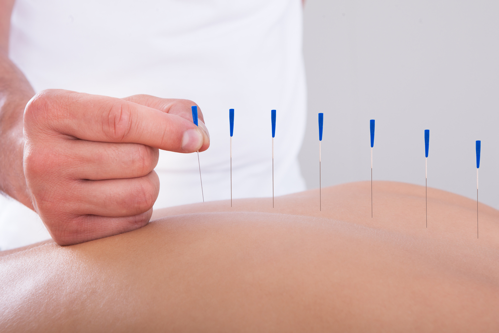 acupuncture.jpg